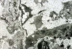 jejunum … lipid malabsorption jejunum … lipid malabsorption
